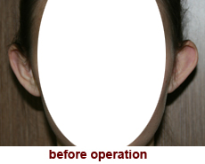 plastic-surgery-prominent-ear 